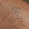 What to Do About Your Varicose Veins