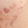 How to Manage Adult Acne